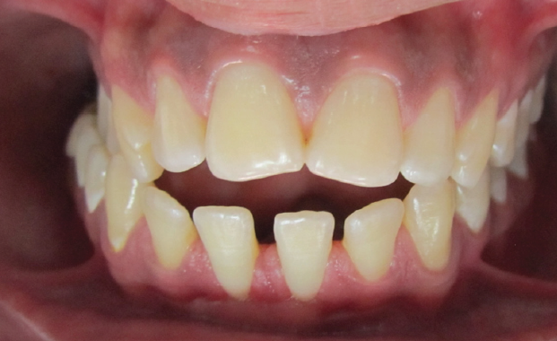 A Case of malocclusion, Class II D1 subdivision left side.