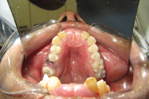A Case of malocclusion, Class II D1 subdivision left side.