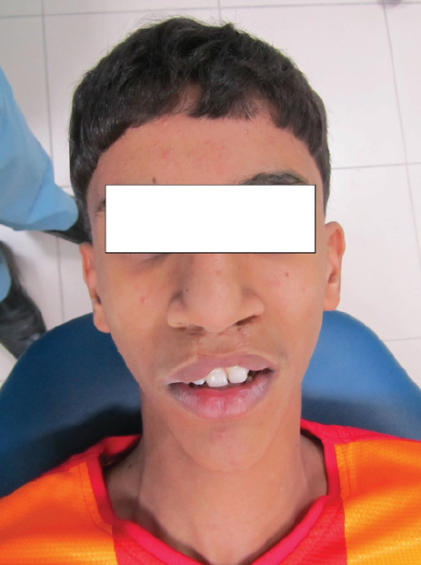 A Case of malocclusion, Class II D1 subdivision left side.