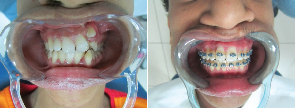 A Case of malocclusion, Class II D1 subdivision left side.