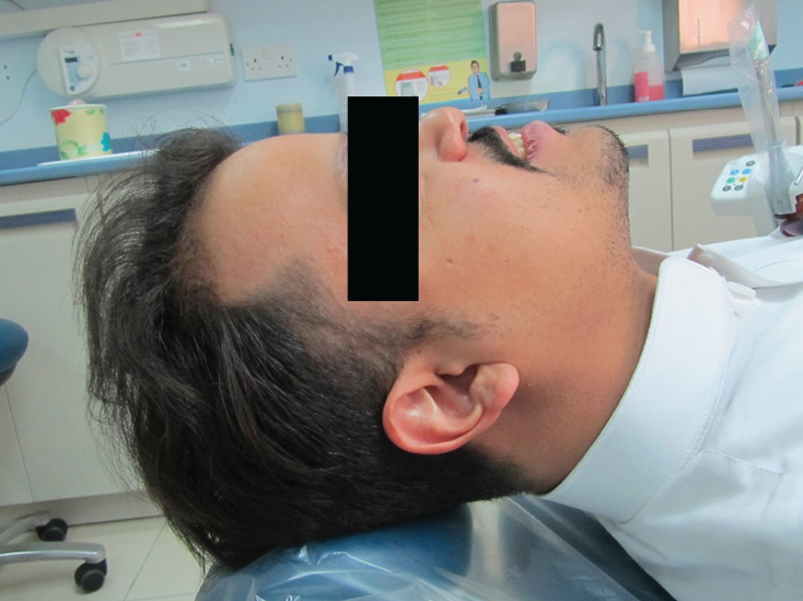 A Case of malocclusion, Class II D1 subdivision left side.